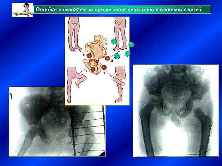 Ошибки и осложнения при лечении переломов и вывихов у детей 