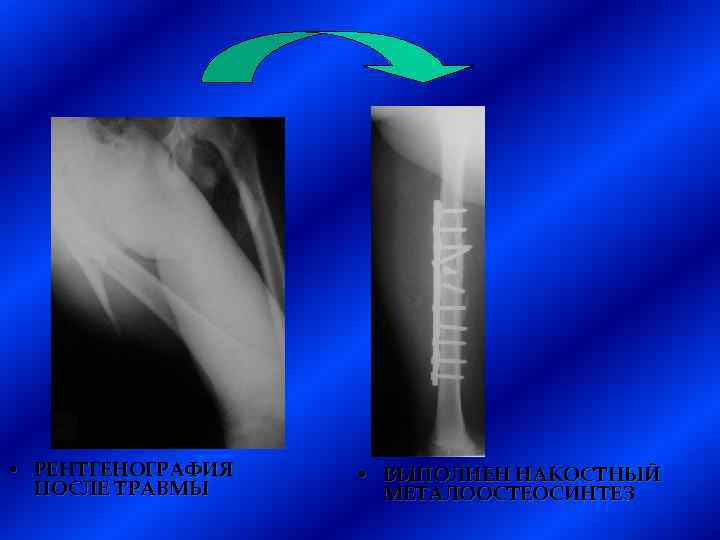  • РЕНТГЕНОГРАФИЯ ПОСЛЕ ТРАВМЫ • ВЫПОЛНЕН НАКОСТНЫЙ МЕТАЛООСТЕОСИНТЕЗ 