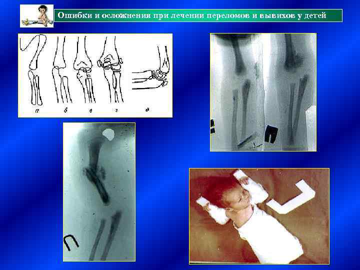 Ошибки и осложнения при лечении переломов и вывихов у детей 