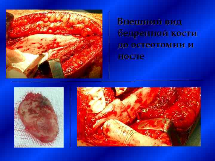 Внешний вид бедренной кости до остеотомии и после 