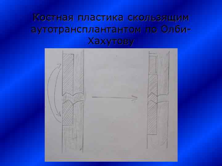 Костная пластика скользящим аутотрансплантантом по Олби. Хахутову 