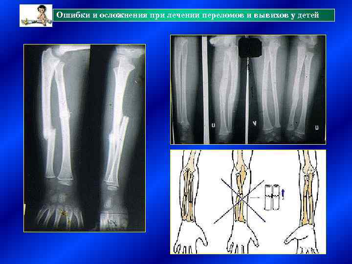 Ошибки и осложнения при лечении переломов и вывихов у детей 
