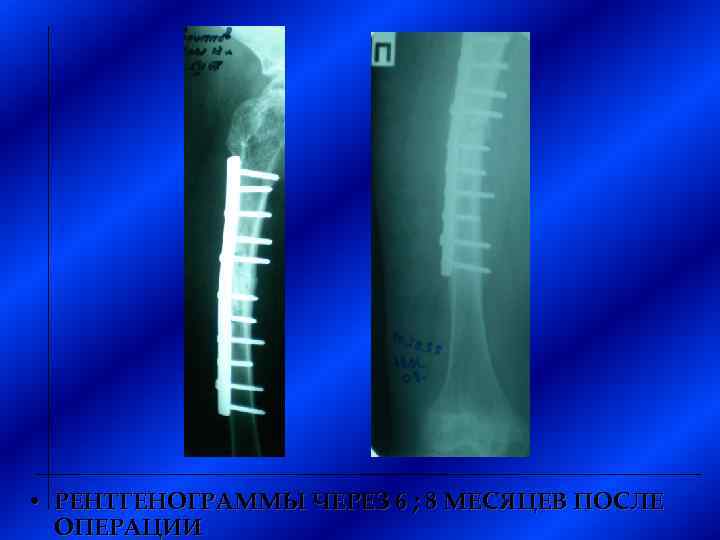  • РЕНТГЕНОГРАММЫ ЧЕРЕЗ 6 ; 8 МЕСЯЦЕВ ПОСЛЕ ОПЕРАЦИИ 