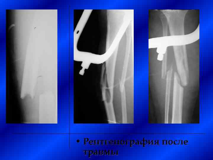  • Рентгенография после травмы 