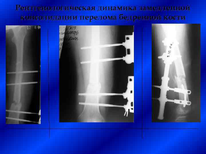 Рентгенологическая динамика замедленной консолидации перелома бедренной кости 