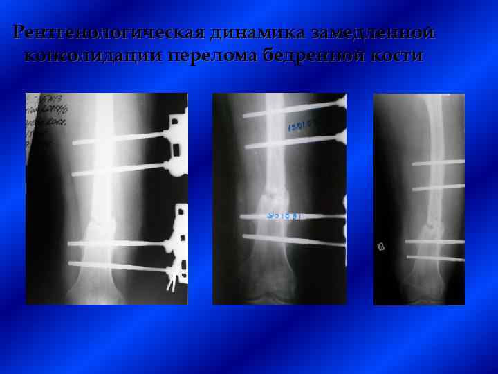 Рентгенологическая динамика замедленной консолидации перелома бедренной кости 