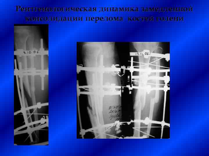 Рентгенологическая динамика замедленной консолидации перелома костей голени 