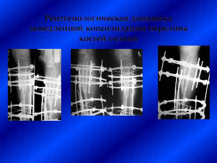 Рентгенологическая динамика замедленной консолидации перелома костей голени 