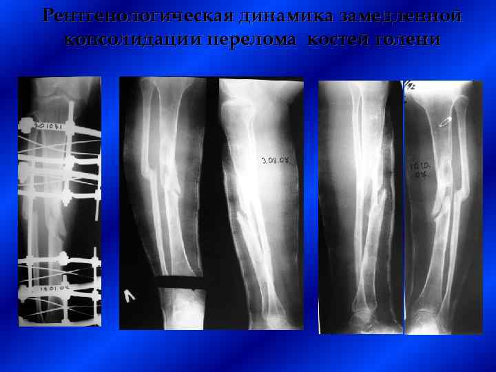 Рентгенологическая динамика замедленной консолидации перелома костей голени 
