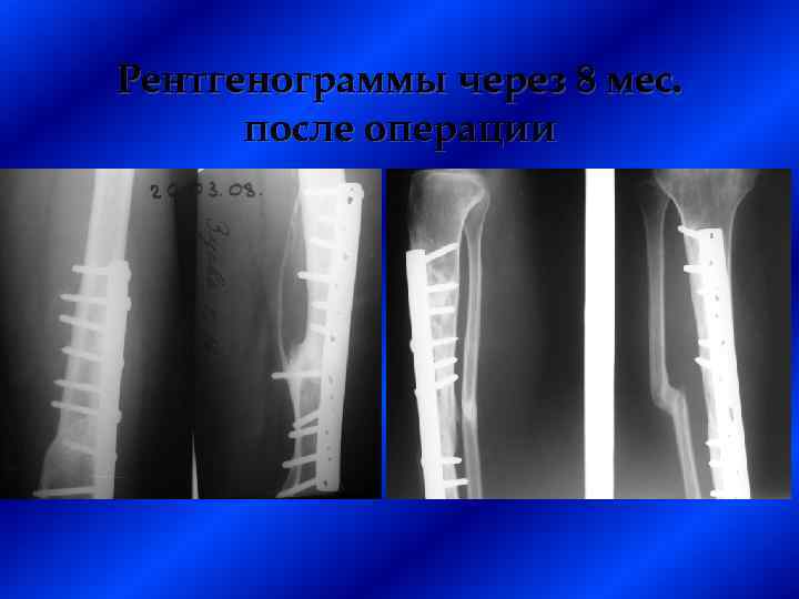 Рентгенограммы через 8 мес. после операции 
