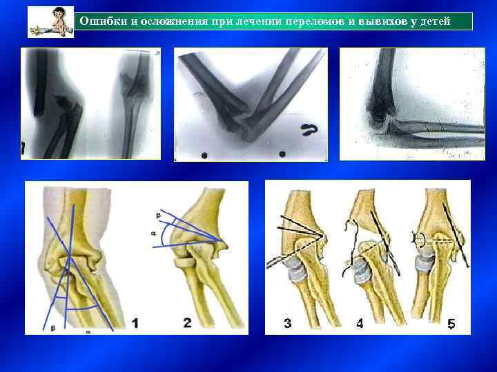 Ошибки и осложнения при лечении переломов и вывихов у детей 