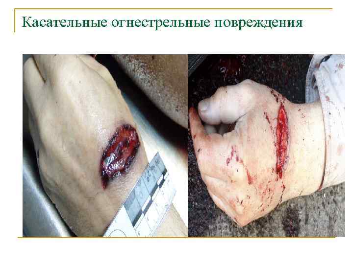 Касательные огнестрельные повреждения 