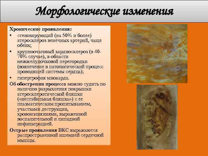 Морфологические изменения Хронические проявления: • стенозирующий (на 50% и более) атеросклероз венечных артерий, чаще