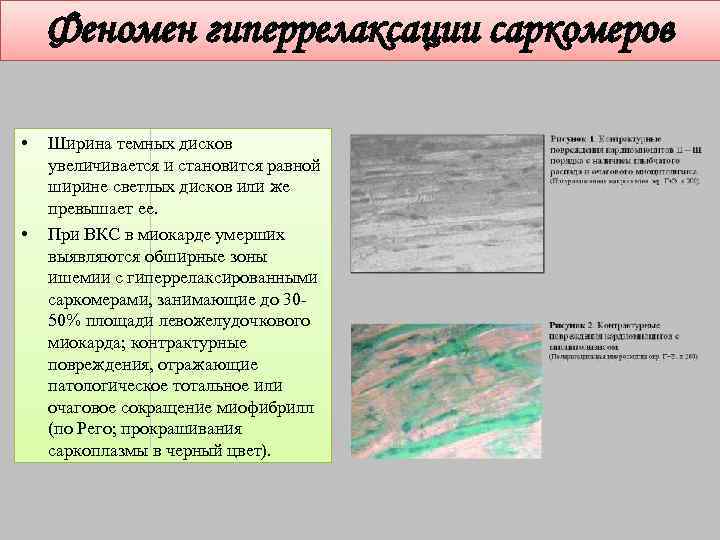 Феномен гиперрелаксации саркомеров • • Ширина темных дисков увеличивается и становится равной ширине светлых