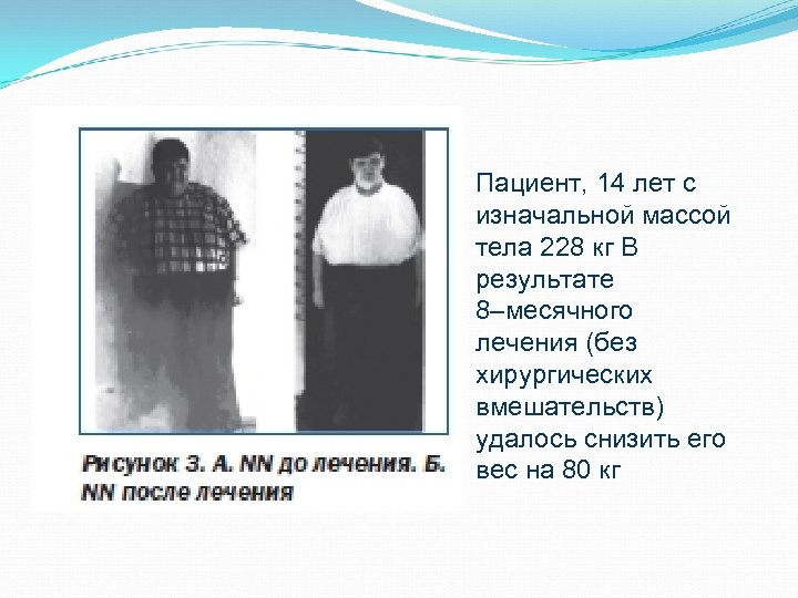 Пациент, 14 лет с изначальной массой тела 228 кг В результате 8–месячного лечения (без