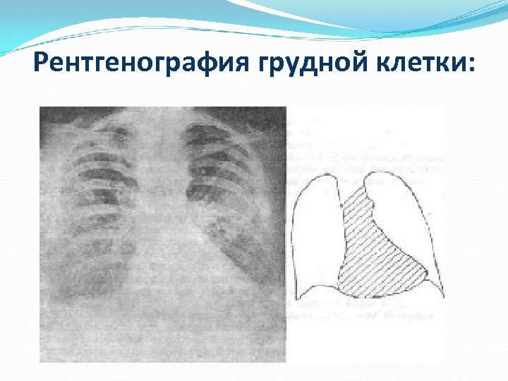 Рентгенография грудной клетки: 