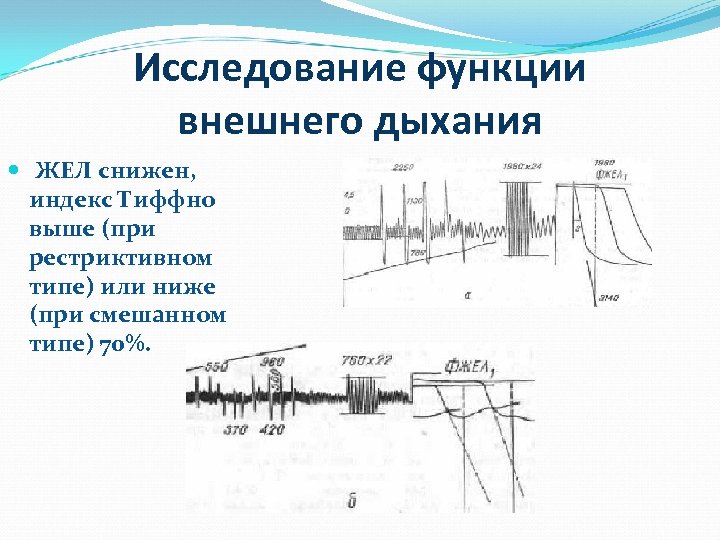 Исследование функции внешнего дыхания ЖЕЛ снижен, индекс Тиффно выше (при рестриктивном типе) или ниже