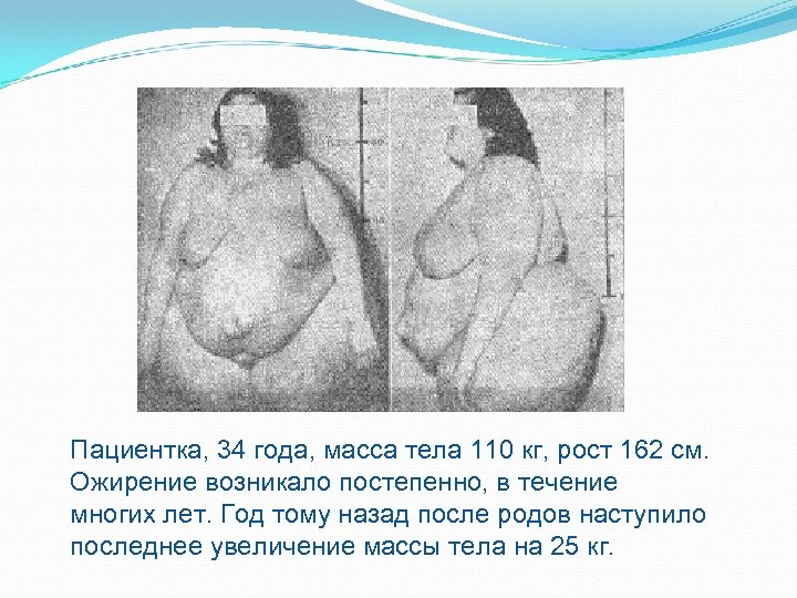 Пациентка, 34 года, масса тела 110 кг, рост 162 см. Ожирение возникало постепенно, в