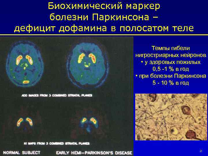 Биохимический маркер болезни Паркинсона – дефицит дофамина в полосатом теле Темпы гибели нигростриарных нейронов