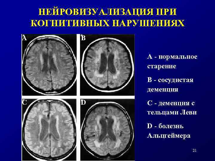 НЕЙРОВИЗУАЛИЗАЦИЯ ПРИ КОГНИТИВНЫХ НАРУШЕНИЯХ А В А - нормальное старение В - сосудистая деменция