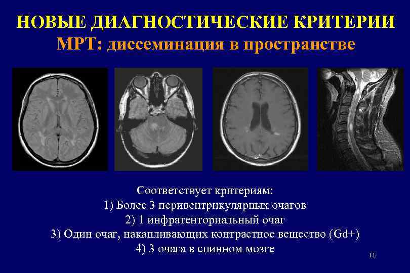 Единичный перивентрикулярный очаг. Рассеянный склероз мрт очаги. Мрт при рассеянном склерозе критерии. Инфратенториальные очаги. Критерии диссеминации в пространстве при рассеянном склерозе.