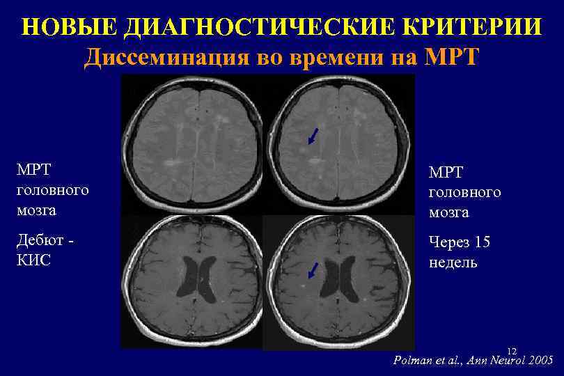 НОВЫЕ ДИАГНОСТИЧЕСКИЕ КРИТЕРИИ Диссеминация во времени на МРТ головного мозга Дебют КИС Через 15