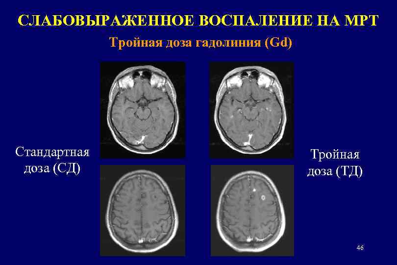 СЛАБОВЫРАЖЕННОЕ ВОСПАЛЕНИЕ НА МРТ Тройная доза гадолиния (Gd) Стандартная доза (СД) Тройная доза (ТД)