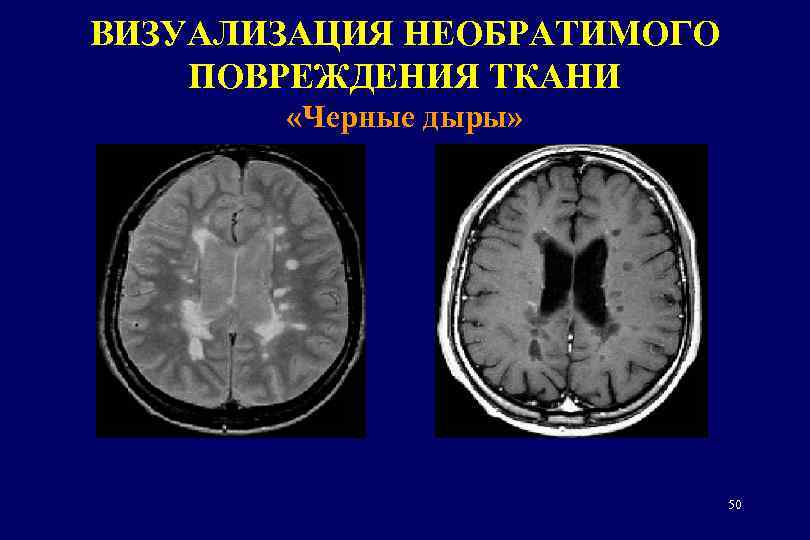 ВИЗУАЛИЗАЦИЯ НЕОБРАТИМОГО ПОВРЕЖДЕНИЯ ТКАНИ «Черные дыры» 50 