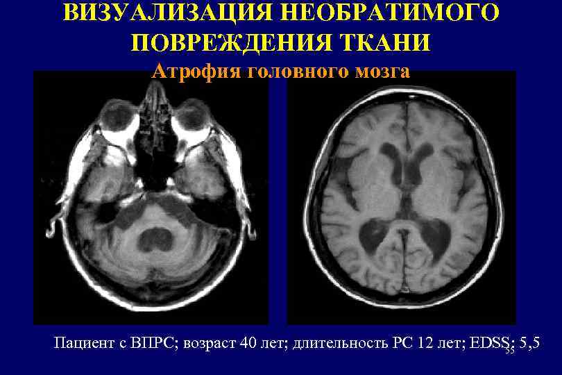 ВИЗУАЛИЗАЦИЯ НЕОБРАТИМОГО ПОВРЕЖДЕНИЯ ТКАНИ Атрофия головного мозга Пациент с ВПРС; возраст 40 лет; длительность