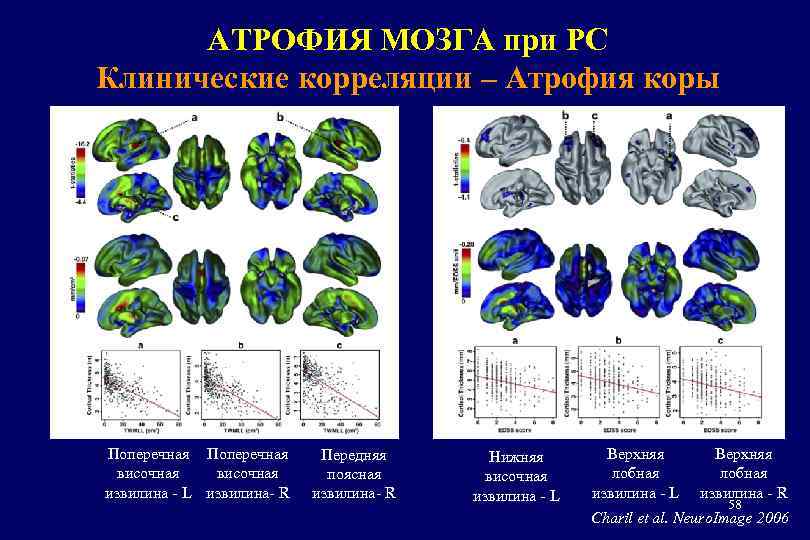 АТРОФИЯ МОЗГА при РС Клинические корреляции – Атрофия коры Поперечная височная извилина - L