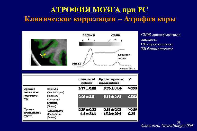 АТРОФИЯ МОЗГА при РС Клинические корреляции – Атрофия коры СМЖ/СВ СМЖ-спинно-мозговая жидкость СВ-серое вещество