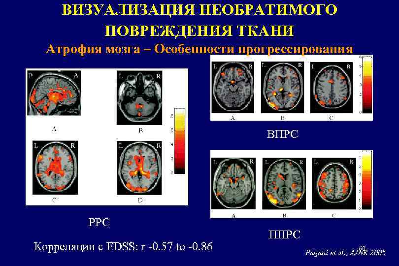 ВИЗУАЛИЗАЦИЯ НЕОБРАТИМОГО ПОВРЕЖДЕНИЯ ТКАНИ Атрофия мозга – Особенности прогрессирования ВПРС РРС Корреляции с EDSS: