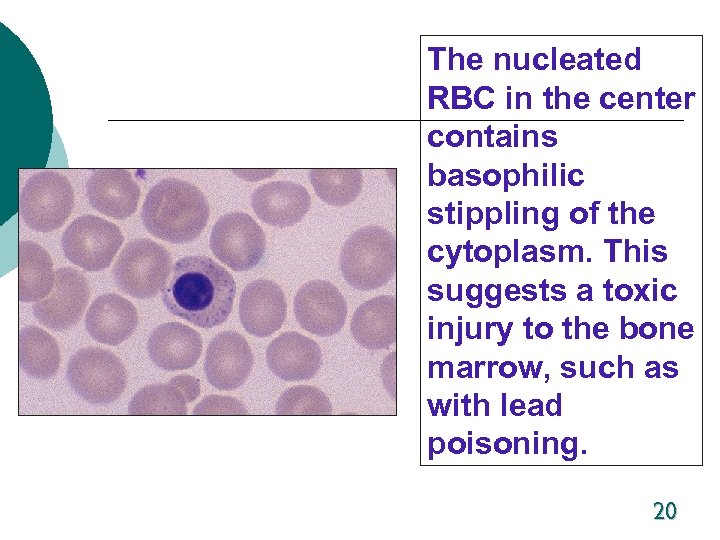 The nucleated RBC in the center contains basophilic stippling of the cytoplasm. This suggests