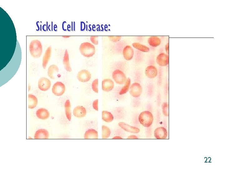Sickle Cell Disease: 22 