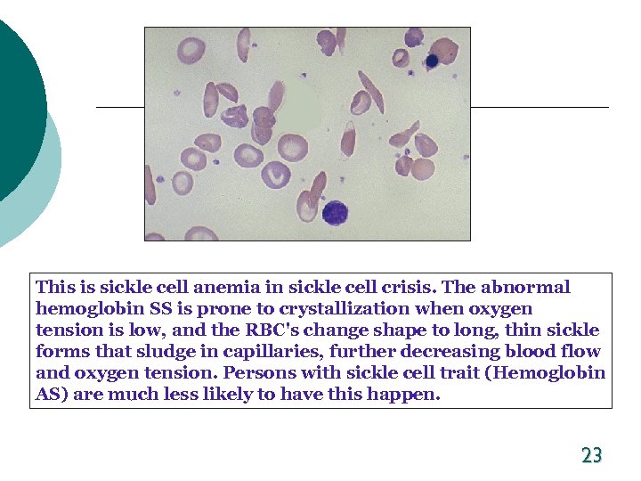 This is sickle cell anemia in sickle cell crisis. The abnormal hemoglobin SS is