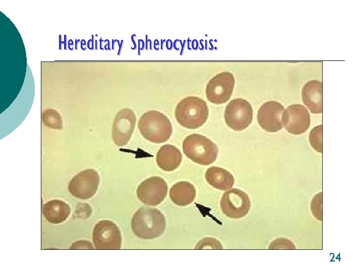 Hereditary Spherocytosis: 24 