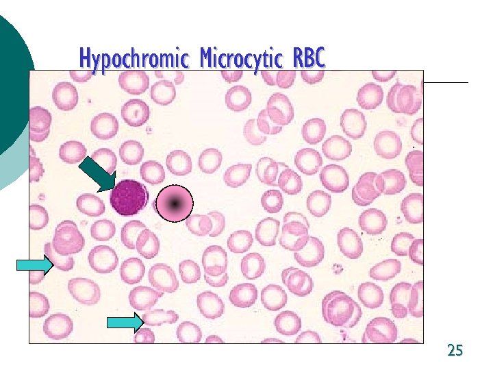 Hypochromic Microcytic RBC 25 