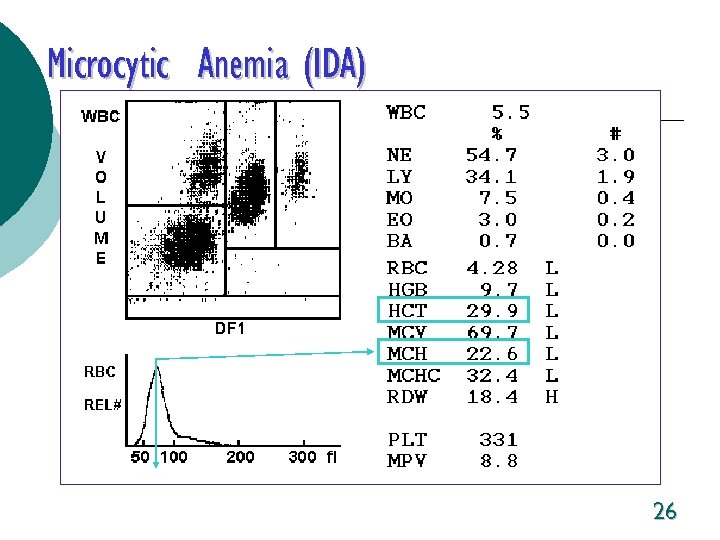 Microcytic Anemia (IDA) 26 