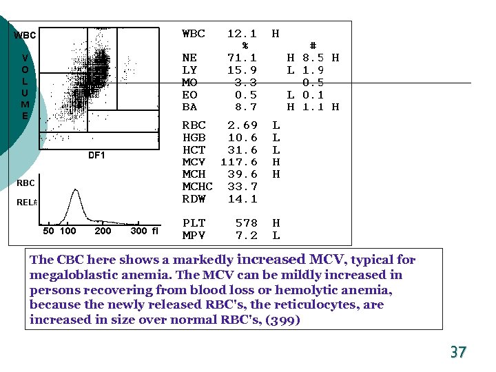 The CBC here shows a markedly increased MCV, typical for megaloblastic anemia. The MCV