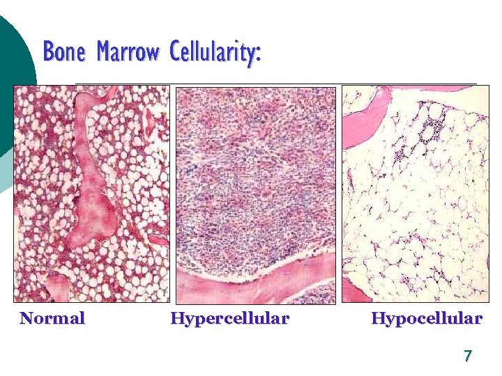Bone Marrow Cellularity: Normal Hypercellular Hypocellular 7 