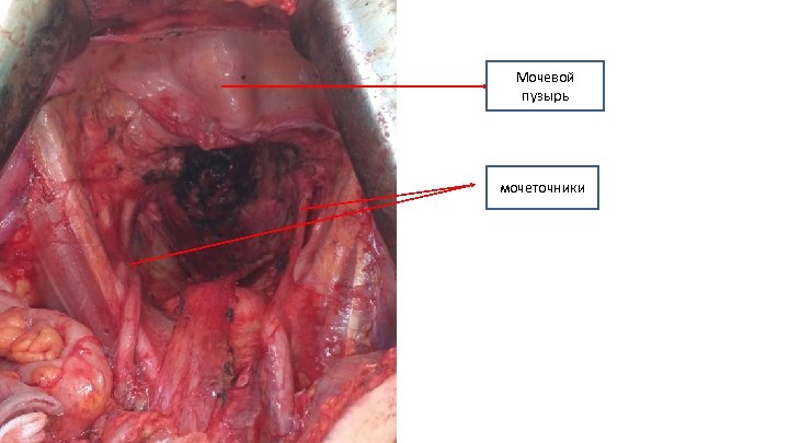 Мочевой пузырь мочеточники 
