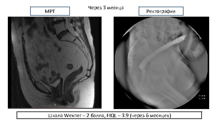 МРТ Через 3 месяца Ректография Шкала Wexner – 2 балла, FIQL – 3. 9