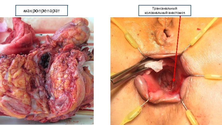 макропрепарат Трансанальный колоанальный анастомоз 