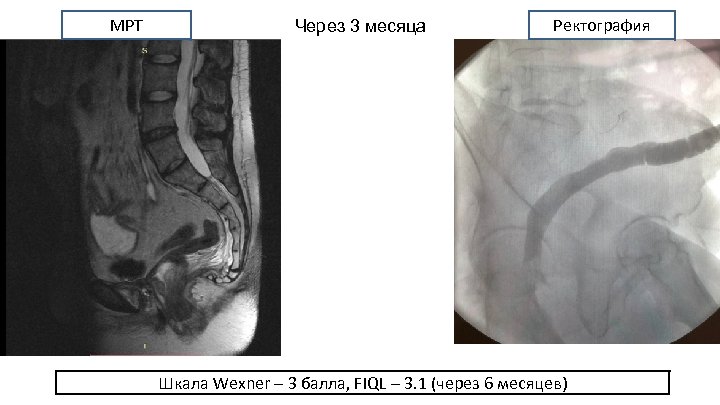 МРТ Через 3 месяца Ректография Шкала Wexner – 3 балла, FIQL – 3. 1