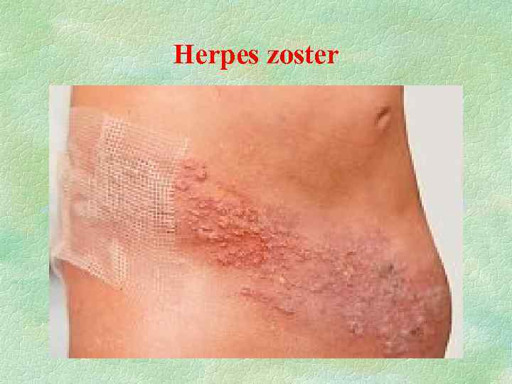 Herpes zoster 