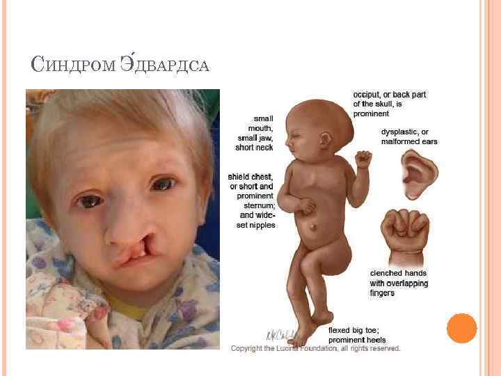 СИНДРОМ Э ДВАРДСА 