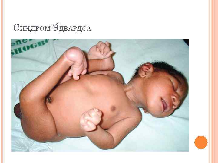 СИНДРОМ Э ДВАРДСА 