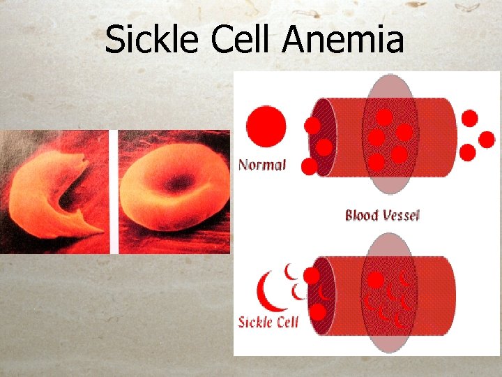 Sickle Cell Anemia 