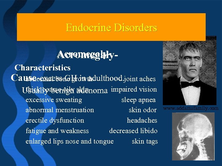 Endocrine Problems Endocrine Disorders Acromegaly. Characteristics Cause-excess GH in adulthood. joint aches abnormal bone