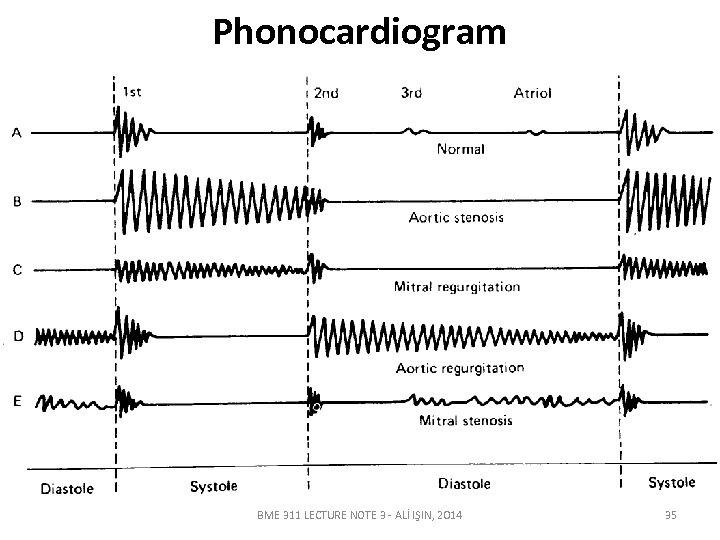 Phonocardiogram BME 311 LECTURE NOTE 3 - ALİ IŞIN, 2014 35 